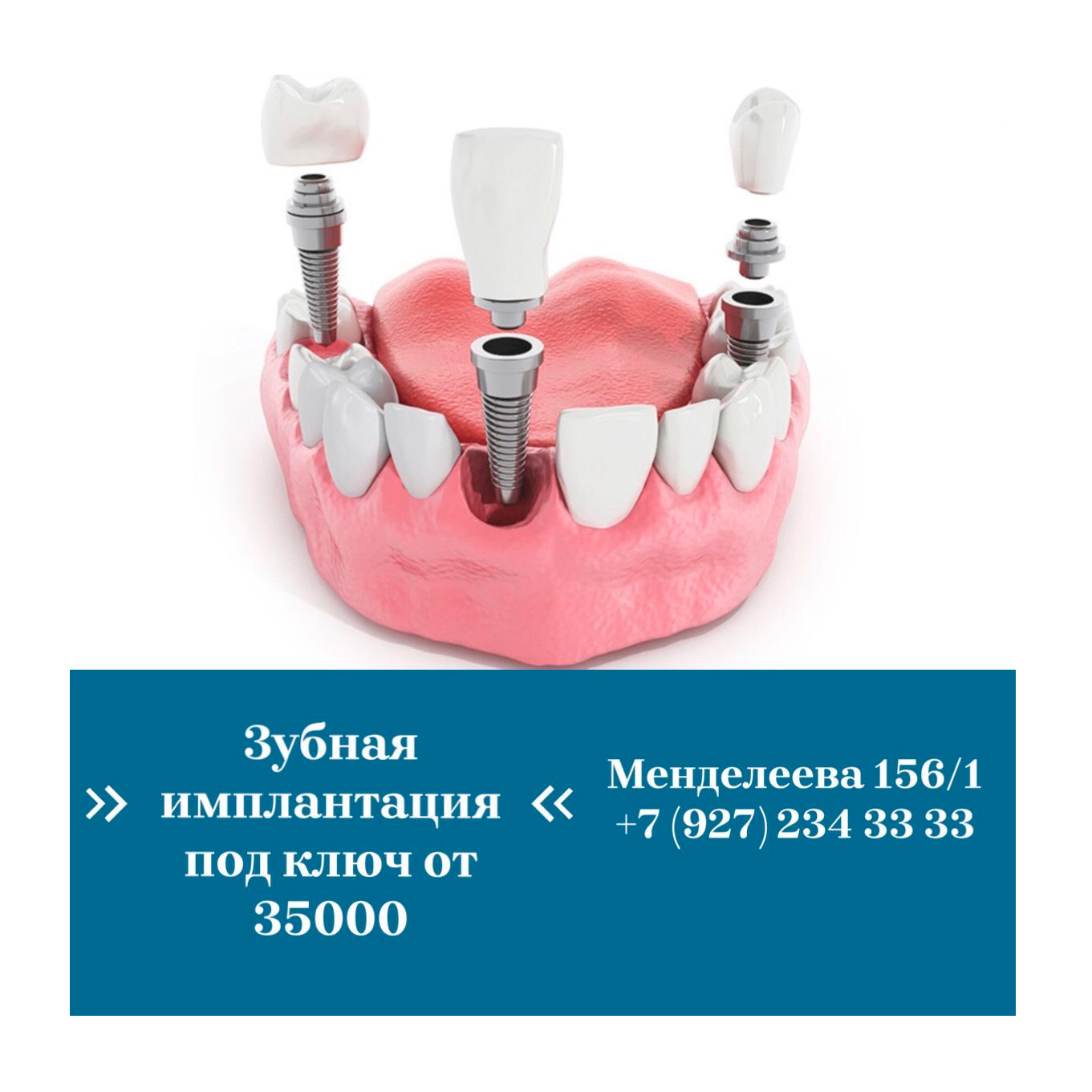 Зубная имплантация под ключ